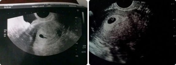 5 Haftalık Gebelik Ultrason Görüntüleri 5 Haftalık Gebelik Ultrason Görüntüleri