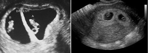 5 Haftalık İkiz Gebelik Ultrason Görüntüleri