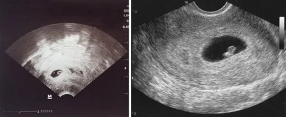 6 Haftalık Bebek Ultrason Görüntüsü 6 Haftalık Bebek Ultrason Görüntüsü