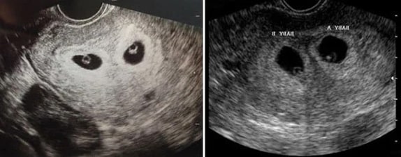 6 Haftalık İkiz Gebelik Ultrason Görüntüleri
