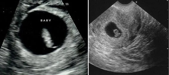 7 Haftalık Bebek Ultrason Görüntüsü