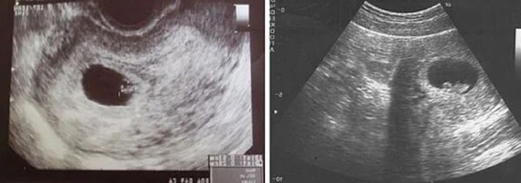 7 Haftalık Gebelik Ultrason Görüntüleri
