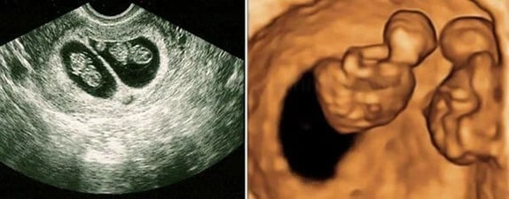 7 Haftalık İkiz Gebelik Ultrason Görüntüleri