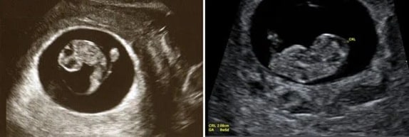 8 Haftalık Bebek Ultrason Görüntüsü