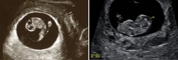 8 Haftalık Bebek Ultrason Görüntüsü 8 Haftalık Bebek Ultrason Görüntüsü
