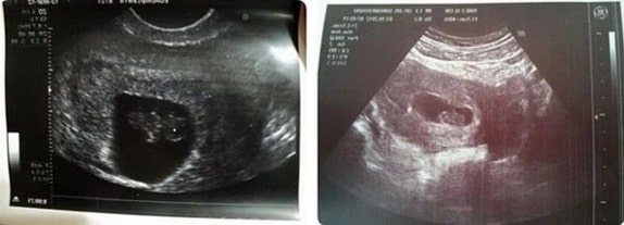 8 Haftalık Gebelik Ultrason Görüntüleri 8 Haftalık Gebelik Ultrason Görüntüleri
