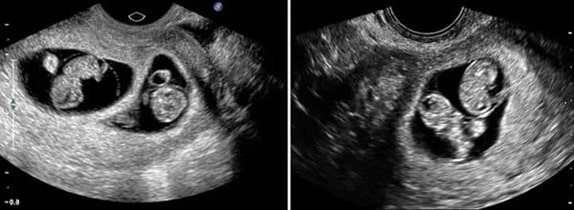 8 Haftalık İkiz Gebelik Ultrason Görüntüleri