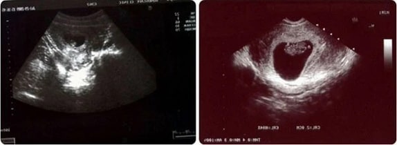 9 Haftalık Bebek Ultrason Görüntüsü