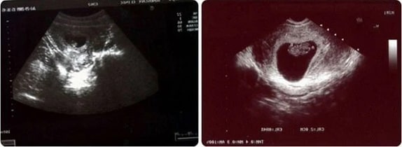 9 Haftalık Bebek Ultrason Görüntüsü 9 Haftalık Bebek Ultrason Görüntüsü