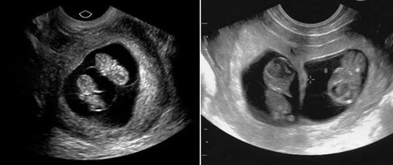 9 Haftalık İkiz Gebelik Ultrason Görüntüleri