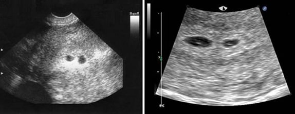 2 Haftalık İkiz Gebelik Ultrason Görüntüleri