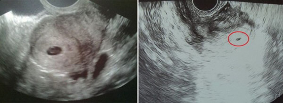 3 Haftalık Bebek Ultrason Görüntüleri 3 Haftalık Bebek Ultrason Görüntüleri
