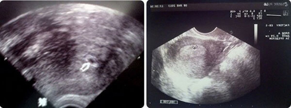 3 Haftalık Gebelik Ultrason Görüntüleri