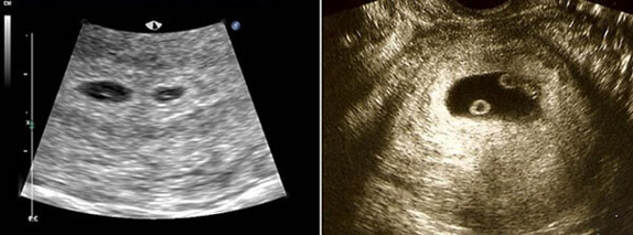 3 Haftalık İkiz Gebelik Ultrason Görüntüleri