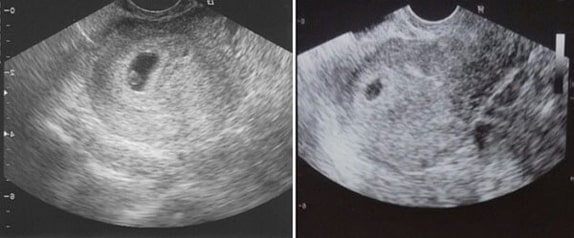 4 Haftalık Bebek Ultrason Görüntüsü