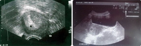 4 Haftalık Gebelik Ultrason Görüntüleri
