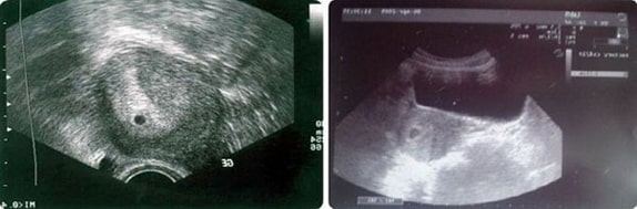 4 Haftalık Gebelik Ultrason Görüntüleri 4 Haftalık Gebelik Ultrason Görüntüleri