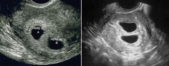 4 Haftalık İkiz Gebelik Ultrason Görüntüleri