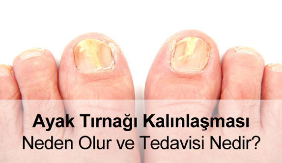 Ayak Tırnağı Kalınlaşması Nasıl Geçer? Tedavisi