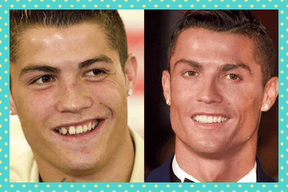 Cristiano Ronaldo Eski Yeni Dişleri