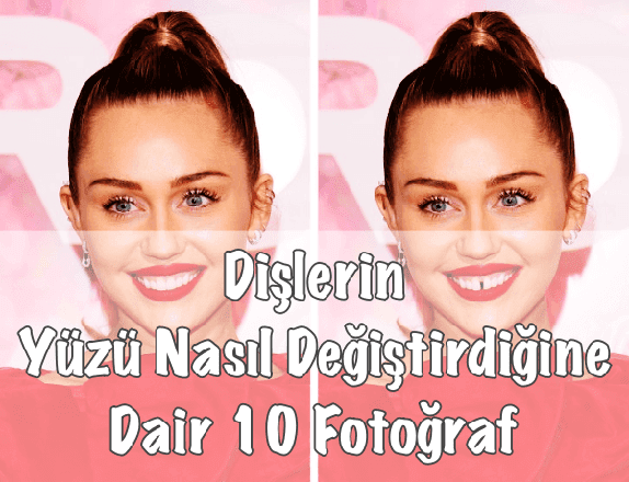 Dişler Yüz Şeklini Değiştirir mi?