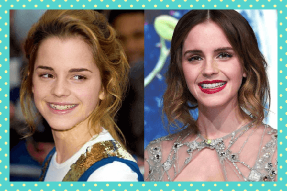 Emma Watson Eski Yeni Dişleri