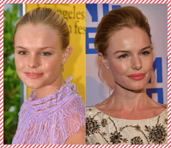 Kate Bosworth Estetik Öncesi ve Sonrası