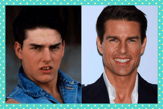 Tom Cruise Eski Yeni Dişleri